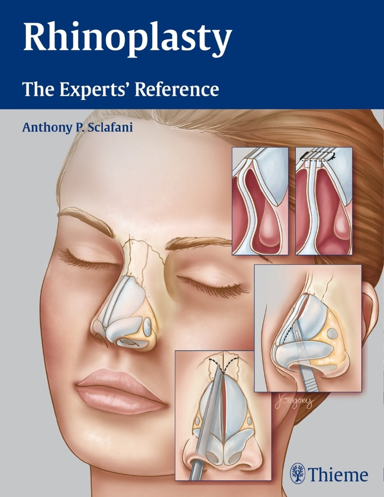 Rhinoplasty (Anthony P. Sclafani)
