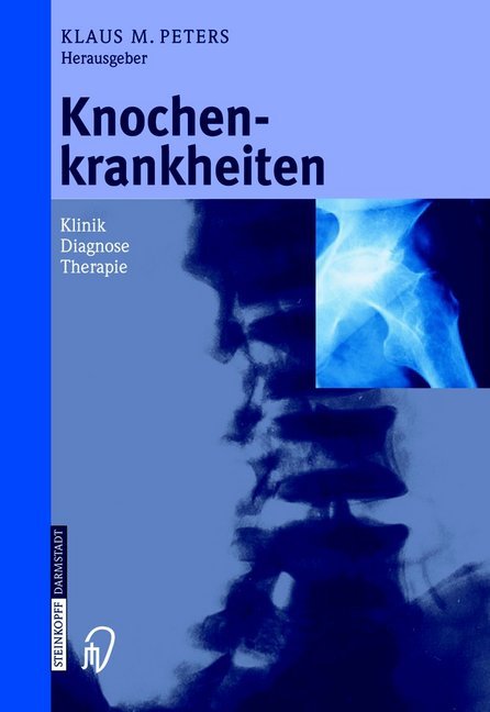 Knochenkrankheiten (Klaus M. Peters)