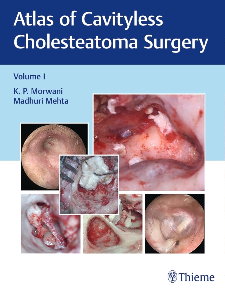 Atlas of Cavityless Cholesteatoma Surgery, Vol 1 (K Morwani)