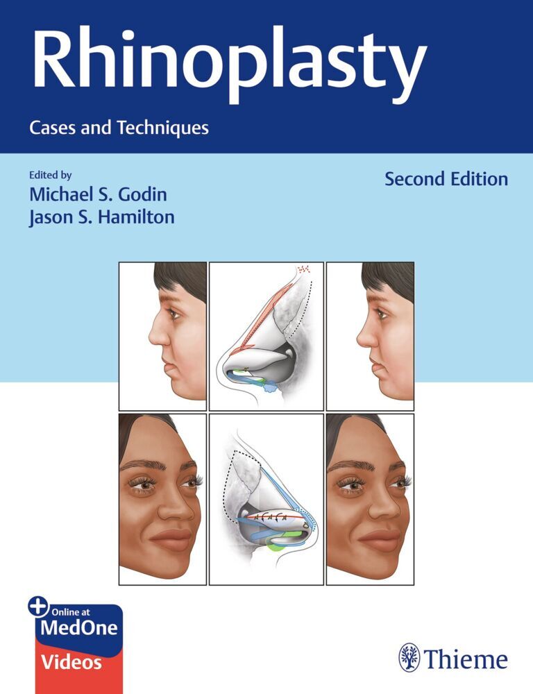 Rhinoplasty (Michael S. Godin)