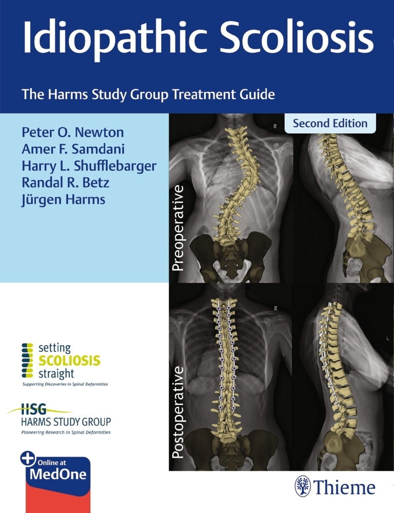 Idiopathic Scoliosis (Peter Newton)